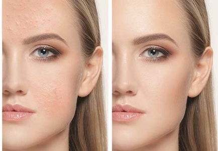 Aknebehandlungsgesicht Mandarin Spa.