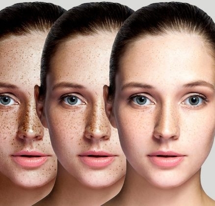 Pigmentbehandlung Mandarin Spa.